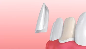 The Porcelain Veneers Process: Step-by-Step Guide from Consultation to Placement